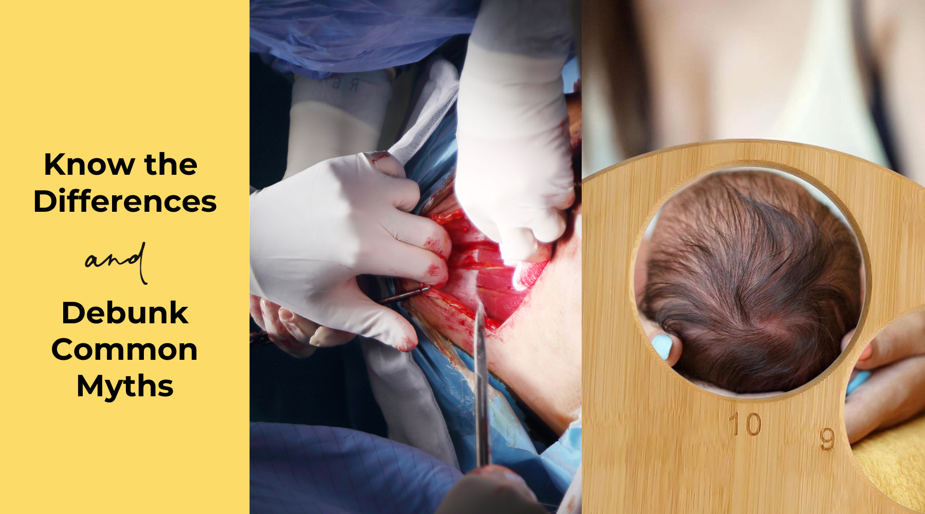 Navigating Birth Choices: Natural vs. C-Section and Busting Common Birth Worries